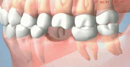 缺牙后的5种后果及常见3种修复方案（看后恍然大悟）