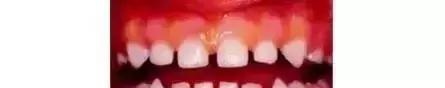 乳牙坏了不用管？12岁小姑娘最终花了16万来切除下颌骨！